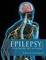Epilepsy