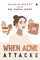 When Acne Attacks